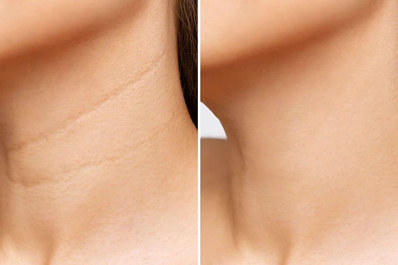 Can You Get Rid of Neck Wrinkles Naturally