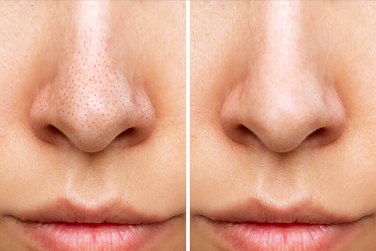 Is There a Way to Permanently Reduce Pore Size