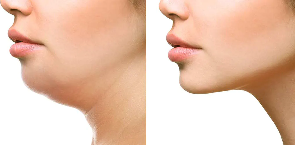 Kybella