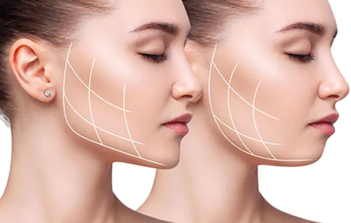 Masseter Botox