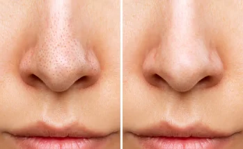 Is There a Way to Permanently Reduce Pore Size